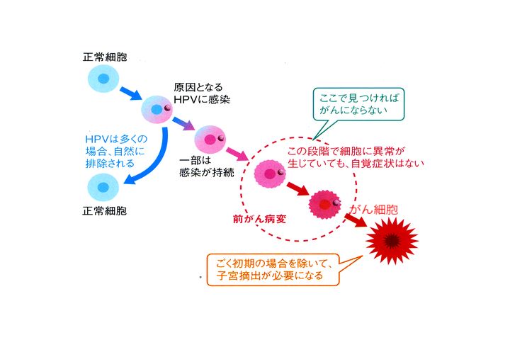 科学朝日 子宮頸がんは予防できる Collaborate With 朝日ニュースター 5月12日放送 拡大写真 論座 朝日新聞社の言論サイト